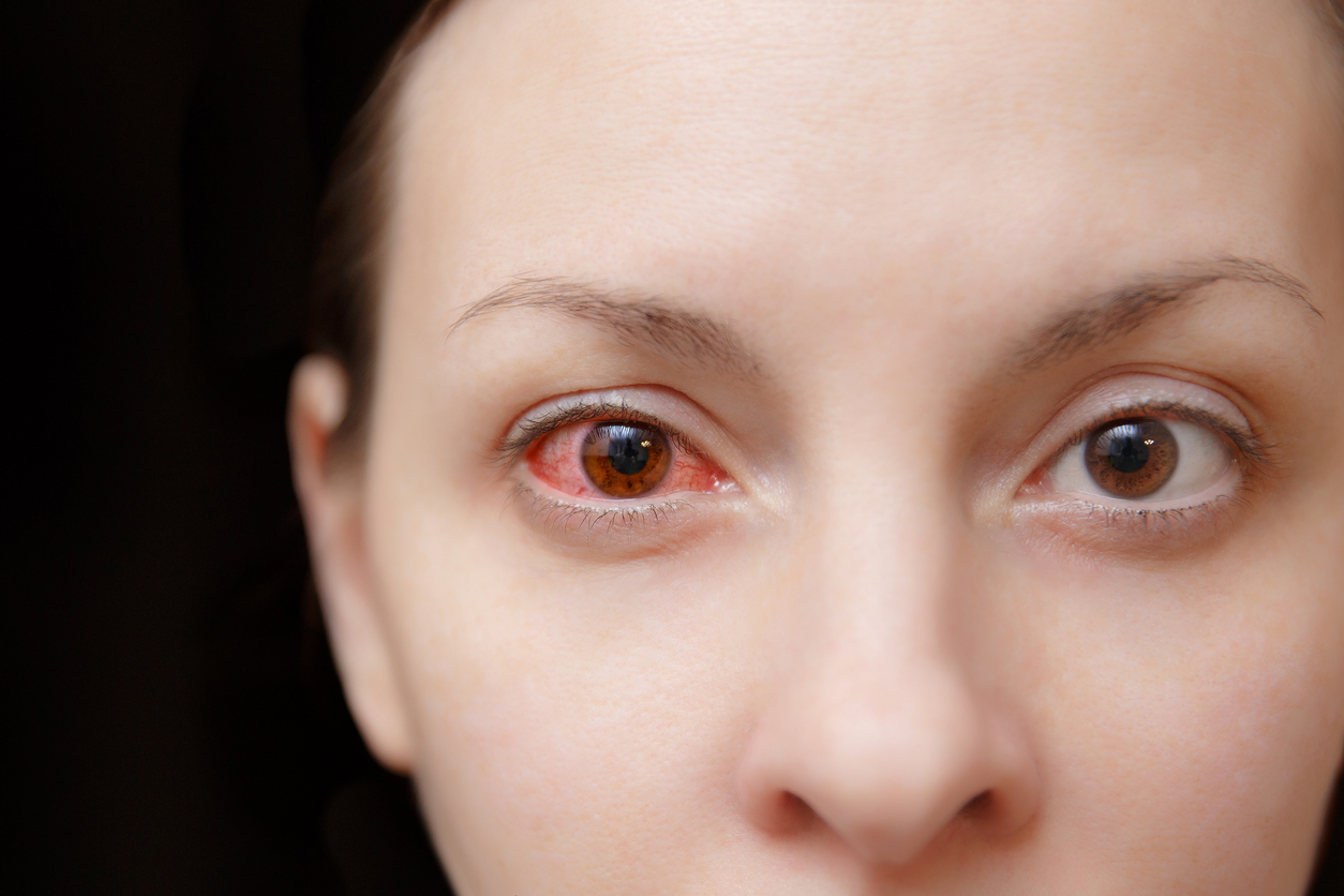 Close up of one annoyed red blood and health eye of female affected by conjunctivitis or after flu, cold or allergy.