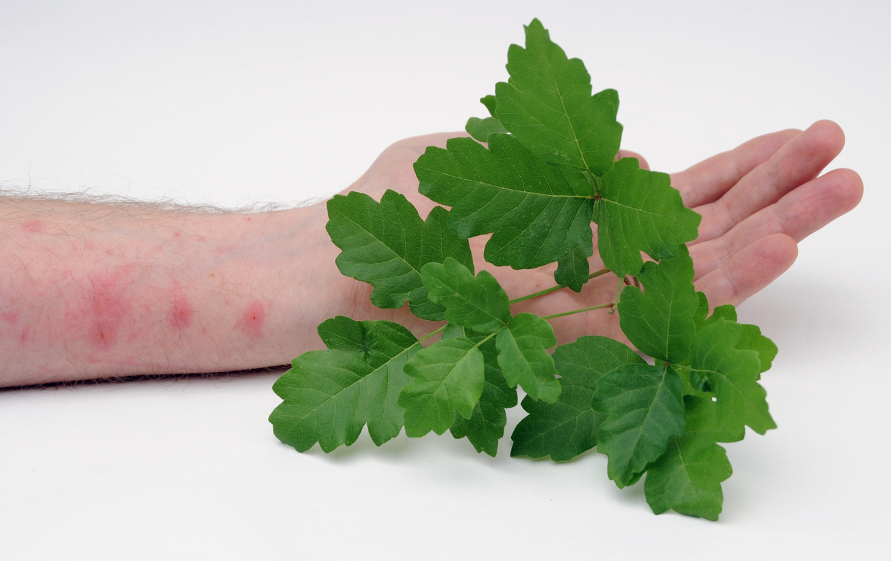 Poison Oak with Skin Rash